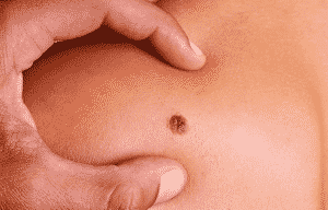 melanoma