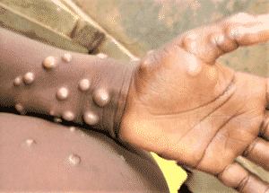 monkeypox