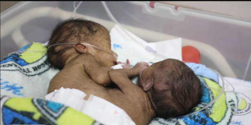 The conjoined twins were born in remote Papua New Guinea