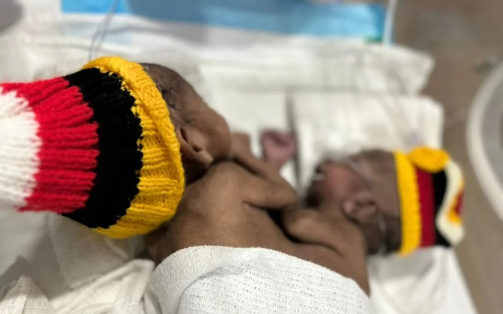 Papua New Guinea conjoined twins.