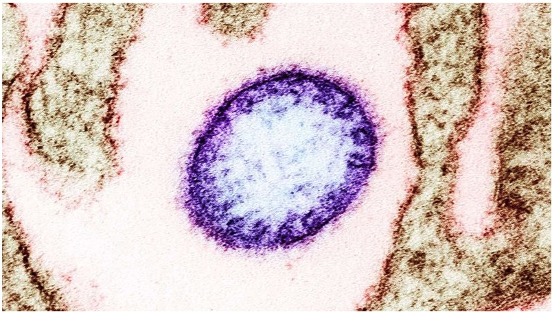 Nipah virus is frequently fatal and can leave survivors with brain damage.